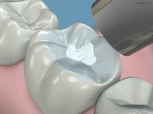 sellador-dental-300x224